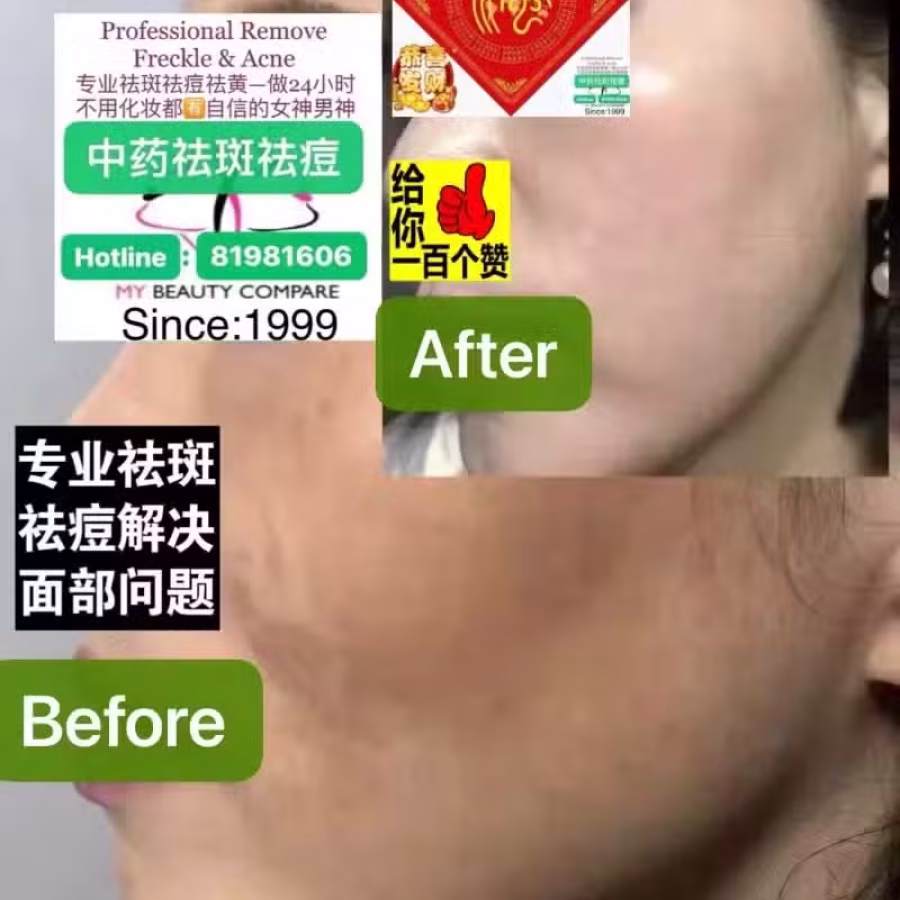 Facial中药专业祛斑痘去黄修护色素管理解决各问题性肌肤HP:81981606 图片 30