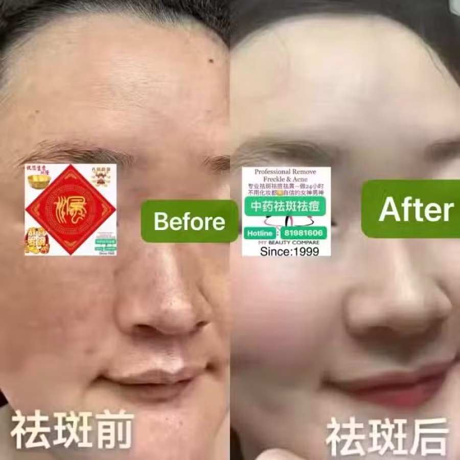Facial中药专业祛斑痘去黄修护色素管理解决各问题性肌肤HP:81981606 图片 28