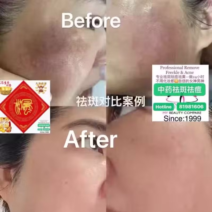 Facial中药专业祛斑痘去黄修护色素管理解决各问题性肌肤HP:81981606 图片 27