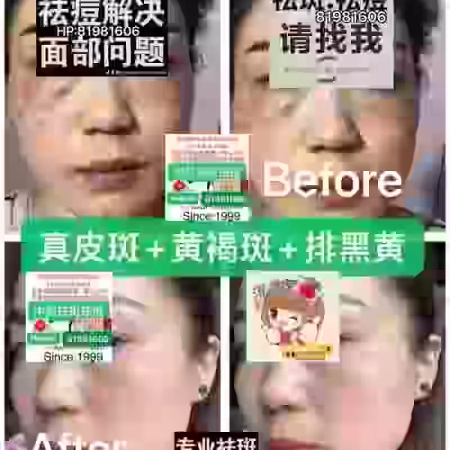中药专业祛斑祛痘修护去痘印痘坑 图片 3