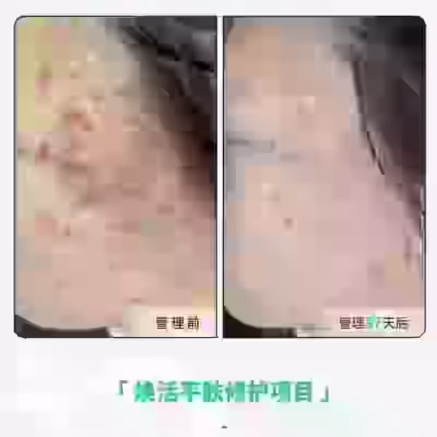 中药专业祛斑祛痘修护去痘印痘坑 图片 21