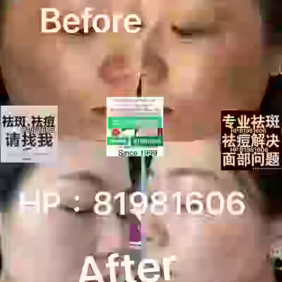 中药专业祛斑祛痘修护去痘印痘坑 图片 22