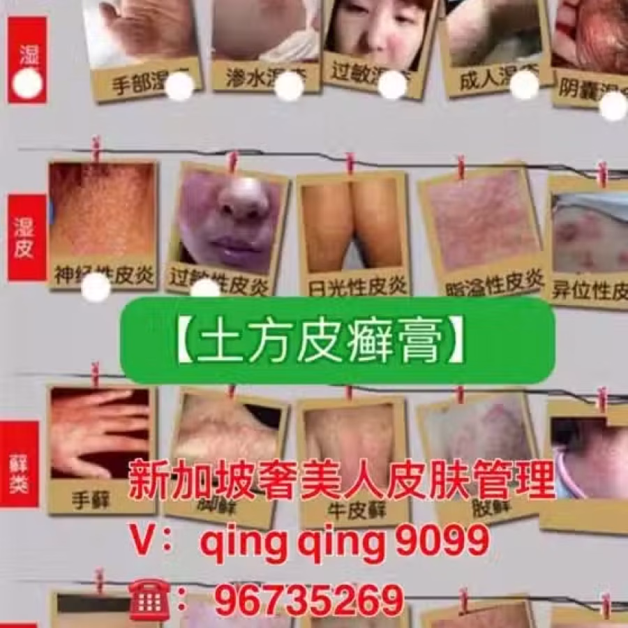 土方皮癣膏牛皮癣药膏土方脚气药膏湿疹寻麻疹皮炎过敏毛囊炎止痒脚气脱皮糜烂脚臭酸臭 图片 17