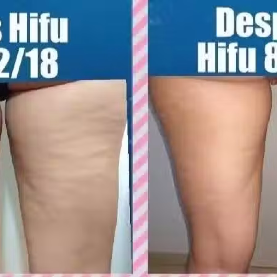 4D HIFU 超声刀 图片 3